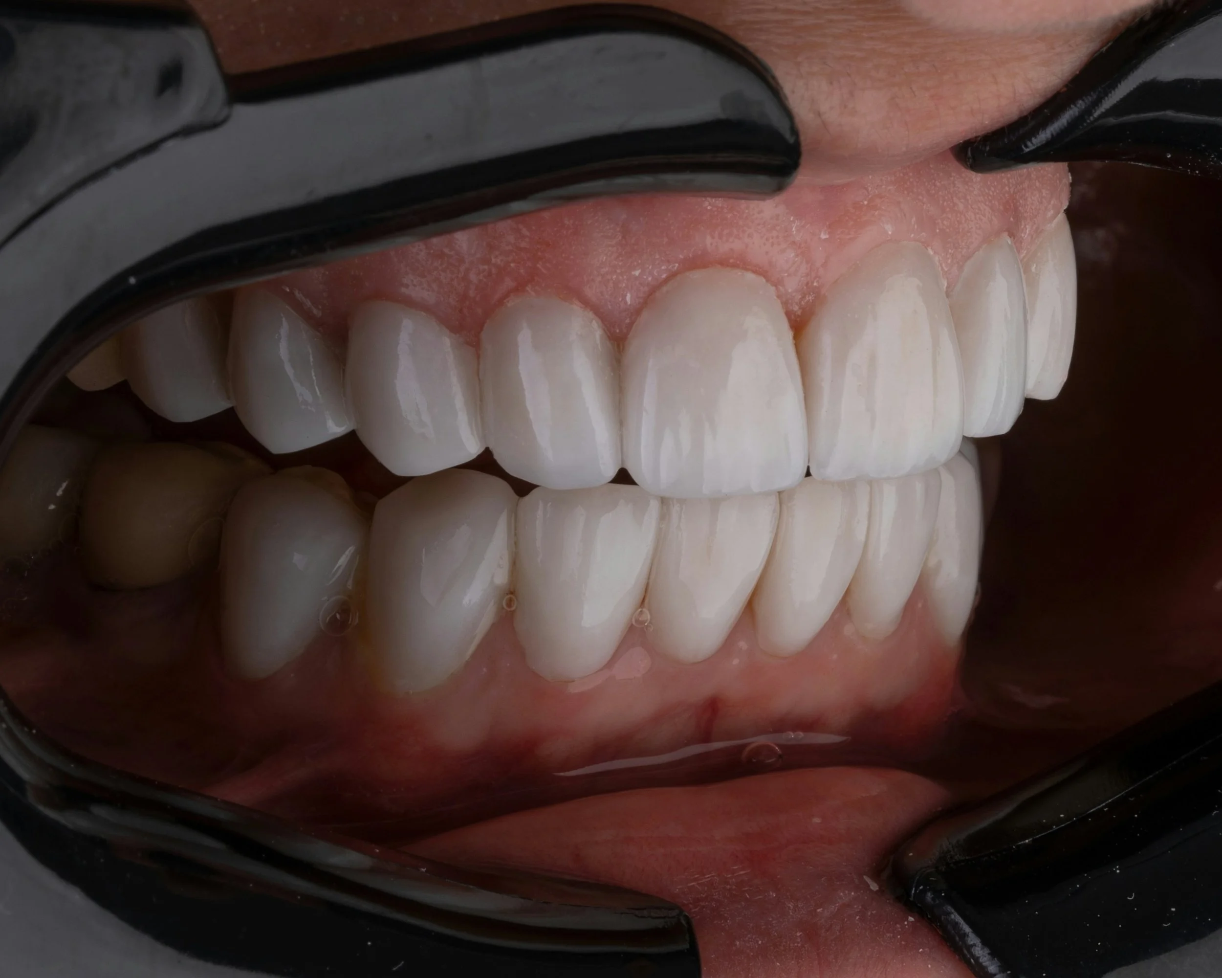 Close-up of a person's mouth with a dental retractor showing clean, aligned teeth and healthy gums during a dental examination or cosmetic dentistry session.