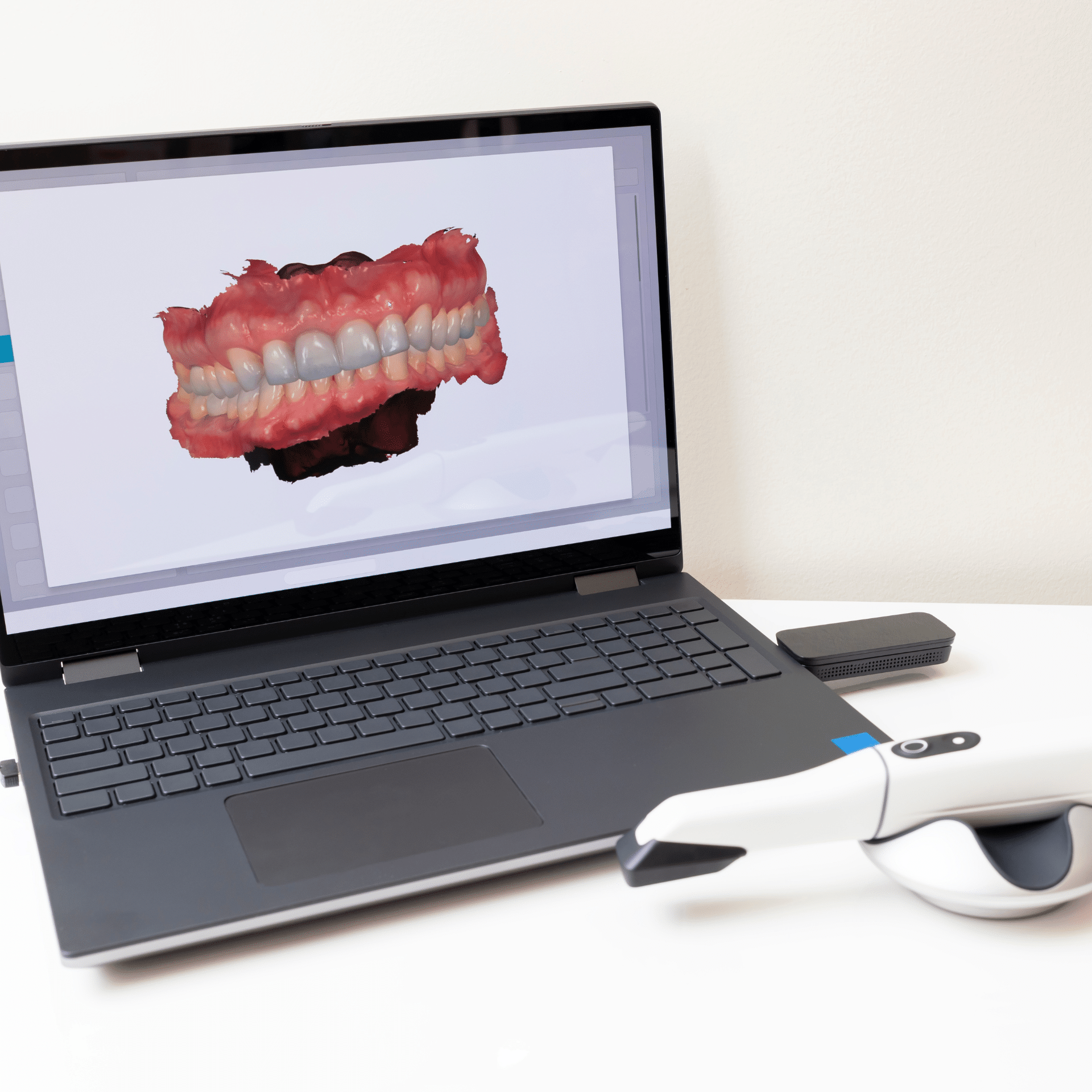 Intraoral Scanner